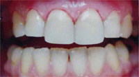 Художественная реставрация зубов, ортопедическая стоматология, лечение десен