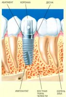 Почему имплантация зубов не может быть дешёвой?