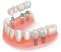 Имплантация зубов имеет ряд противопоказаний