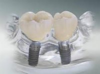 Нюансы и секреты имплантации зубов