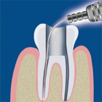 Вкладки - современные подходы к лечению зуба