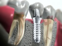 Имплантация зубов - новый шанс красивой улыбки