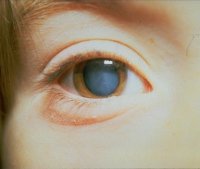 Лечение катаракты гомеопатическими препаратами