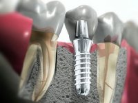 Общая информация об имплантации зубов