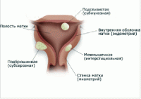 Женские проблемы - рак матки
